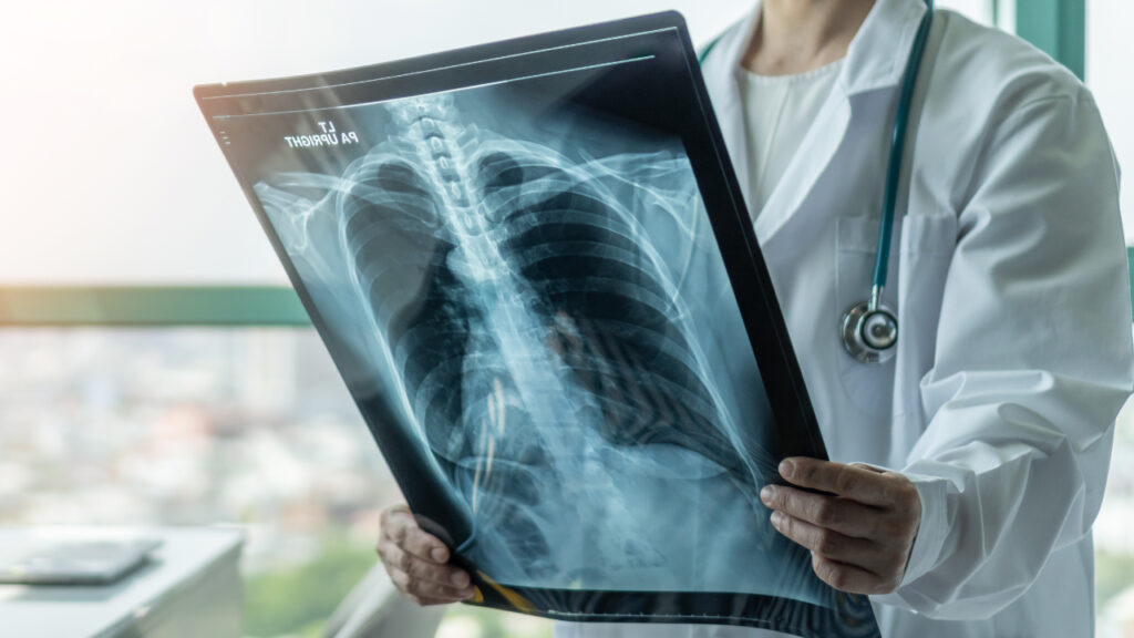 doctor examining an X-ray of a lung